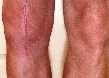 Отек ноги после операции на тазобедренном суставе