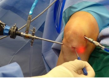 Артроскопия коленного сустава при повреждении менисков: описание методов и техник