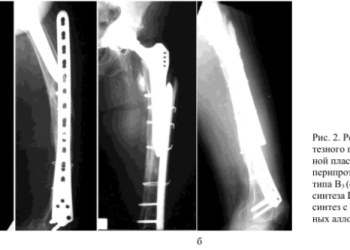 Перипротезные переломы и трещины костей при эндопротезировании суставов