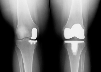 Эндопротезирование коленного сустава – шанс восстановить функции конечности