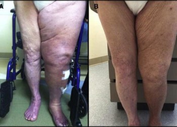 Отек после эндопротезирования тазобедренного и коленного сустава: как убрать