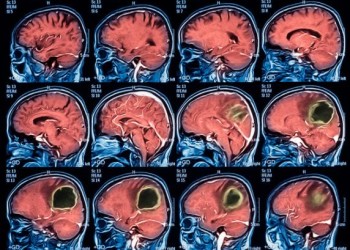Операция по удалению абсцесса головного мозга: симптомы, лечение и последствия