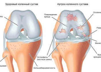 Гонартроз коленного сустава 3 и 4 степени: прогноз выздоровления