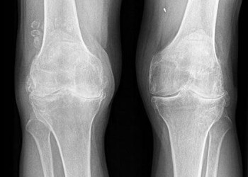 Противопоказания для эндопротезирования коленного сустава: список