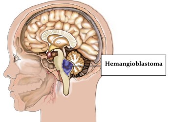 Гемангиобластома головного мозга: статистика, причины, симптомы, лечение и операция
