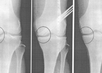 Артроскопия при артрозе (гонартрозе) коленного сустава: помогает или нет?