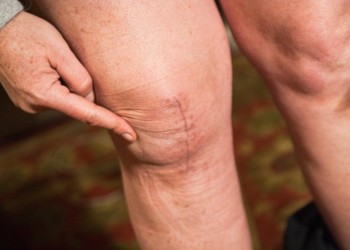 Массаж коленного сустава после операции эндопротезирования: польза и вред, правила выполнения