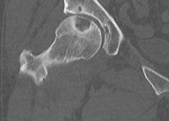 Кисты вертлужной впадины и головки бедренной кости: лечение и операции тазобедренного сустава