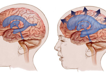 Гидроцефалия головного мозга: признаки, диагностика, лечение, операция, цены