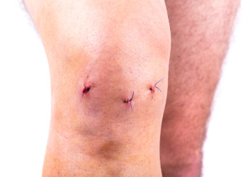 Артроскопия коленного сустава: секреты правильной реабилитации после операции