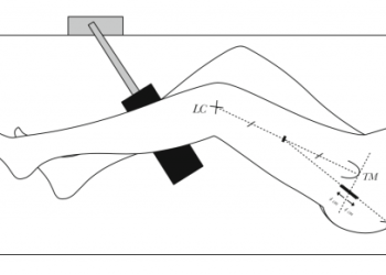 Анализ успешности задне-бокового доступа при эндопротезировании тазобедренного сустава