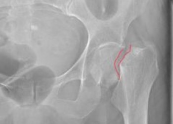 Перелом шейки бедра тазобедренного сустава: виды, лечение пожилых и последствия операции