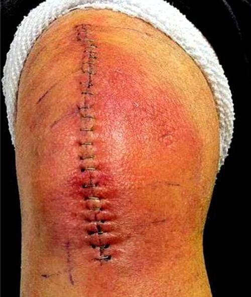 Изображение - Повторное эндопротезирование коленного сустава infektsiya-kolena