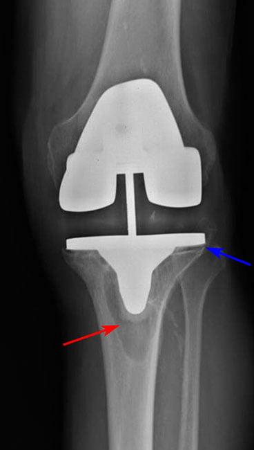 Изображение - Повторное эндопротезирование коленного сустава iznos-kolennogo-proteza