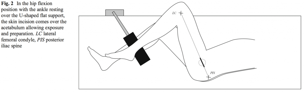 Рис 2. В позиции, когда бедро согнуто, а голеностоп помещается на U-образной опоре, разрез проходит над вертлужной впадиной и обеспечивает хороший досткп к месту протезирования. LC боковой мыщелок, PIS - задняя подвздошная кость.