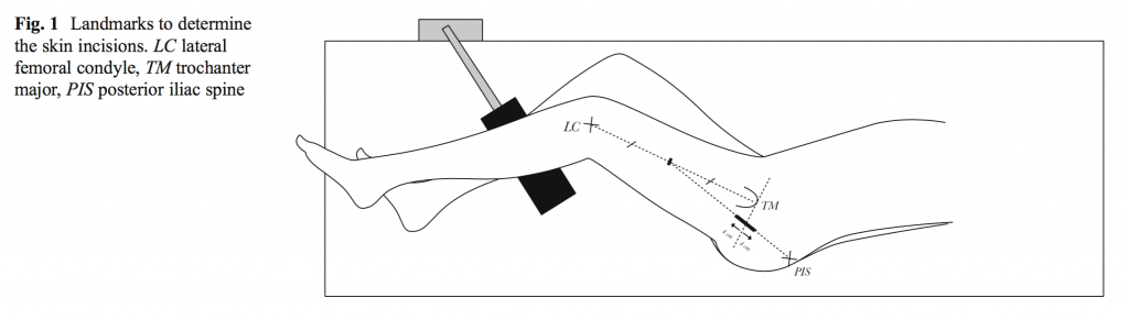Рис 1. Метки для обозначения места нанесения разреза. LC боковой мыщелок, ТМ главный вертел, PIS - задняя подвздошная кость.
