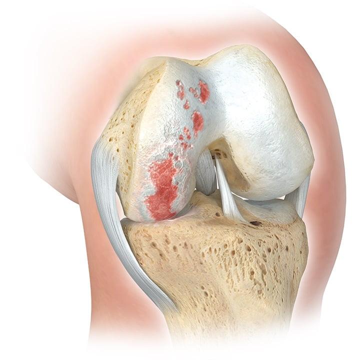 Изображение - Частичное протезирование коленного сустава chastichnoe-protezirovanie