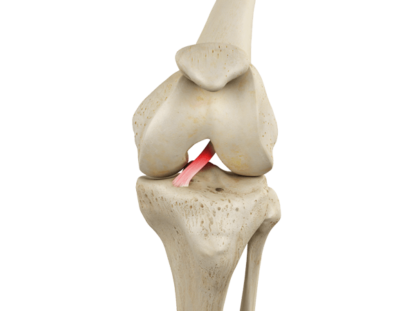 Изображение - Артроскопия передней крестообразной связки коленного сустава PKS1
