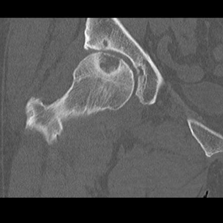 Кисты вертлужной впадины и головки бедренной кости: лечение и операции тазобедренного сустава
