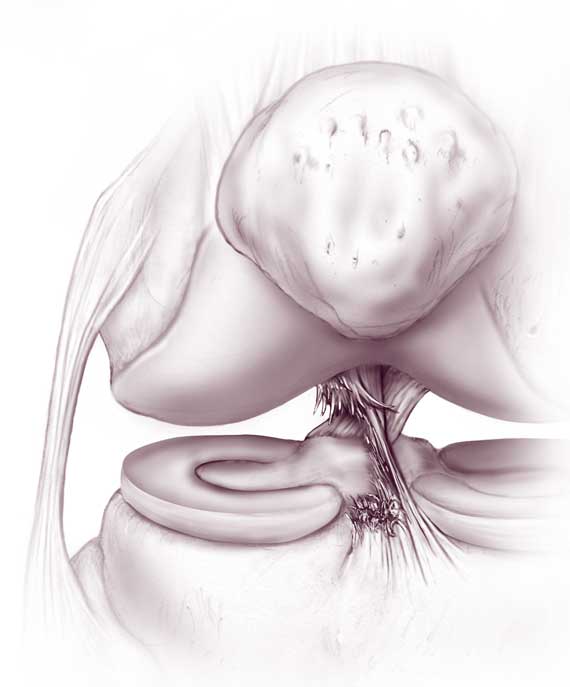 Изображение - Артроскопия передней крестообразной связки коленного сустава pks-razryv