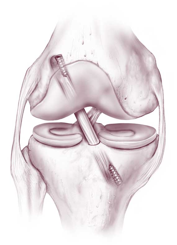 Изображение - Артроскопия передней крестообразной связки коленного сустава plastika