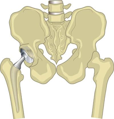 Изображение - Формирование ложного сустава при переломе шейки бедра protez-TBS