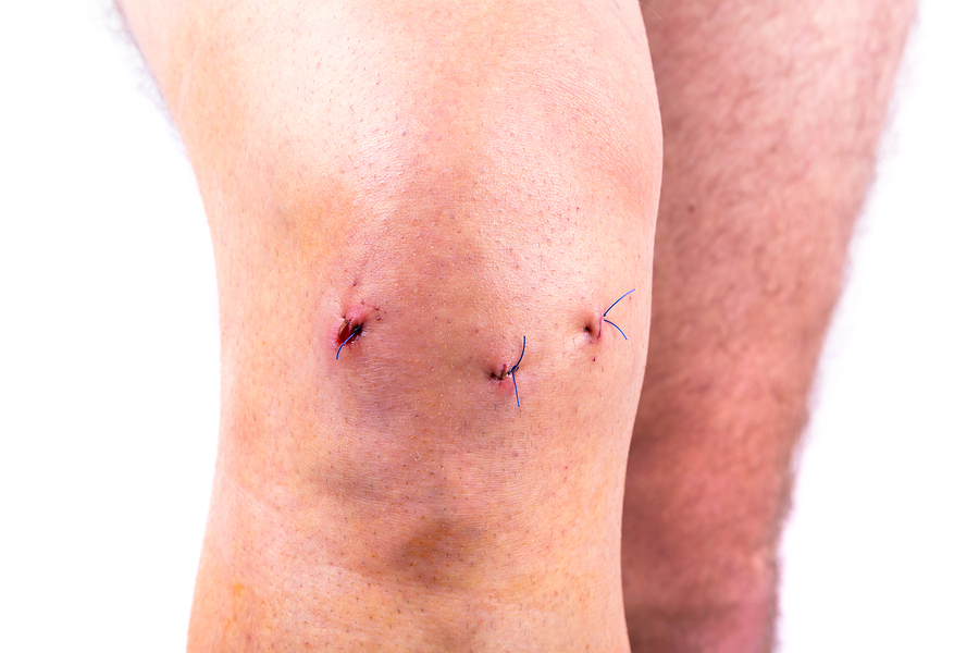 Болит колено после артроскопии тазобедренного сустава