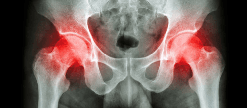 Почему болит колено после замены тазобедренного сустава