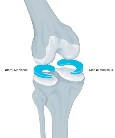 Хирургия и последующая реабилитация мениска коленного сустава