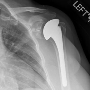 Рентген после эндопротезирования плечевого сустава