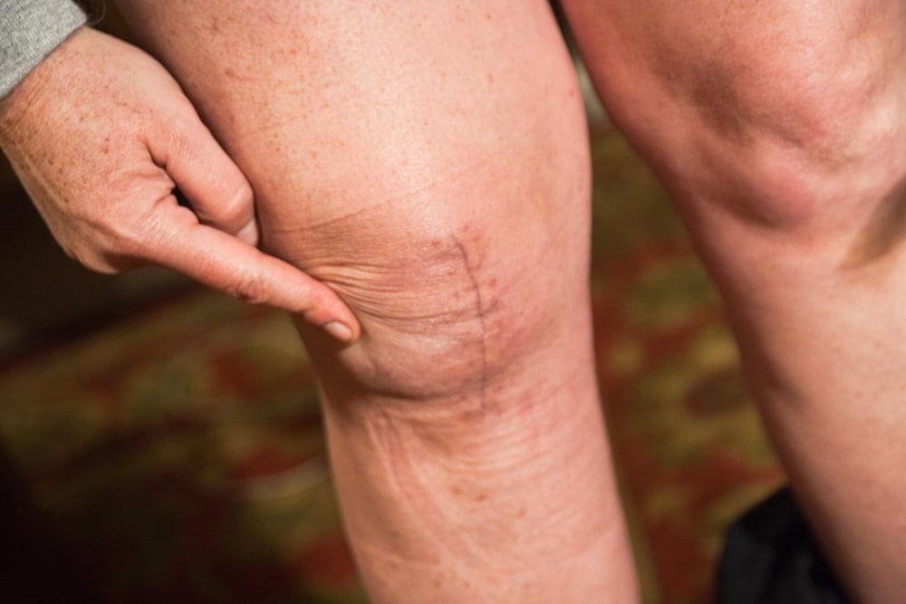 Массаж коленного сустава после операции эндопротезирования: польза и вред, правила выполнения