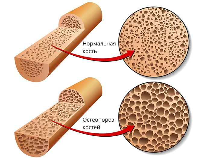 osteoporoz1