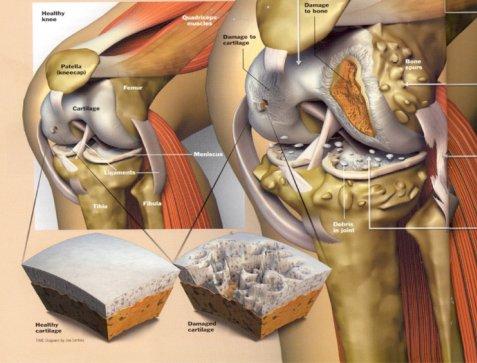 Степени артроза коленного сустава лечение