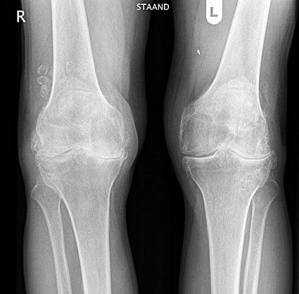 Остеоартроз коленного сустава санаторий