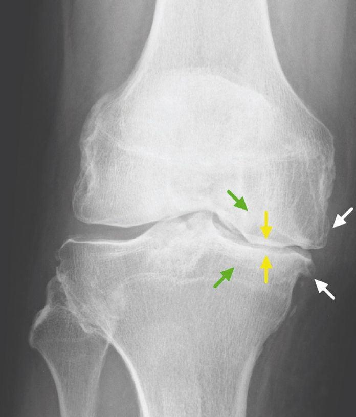 Гонартроз коленного сустава: что это, анализ заболевания и способов лечения
