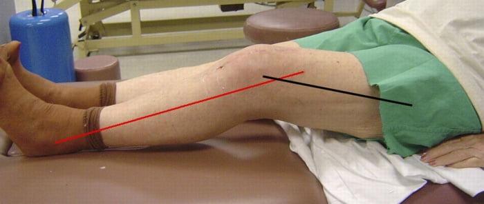 Изображение - Гемартроз после артроскопии коленного сустава kontrakturaa-1