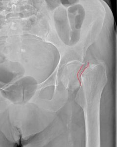 Перелом шейки бедра тазобедренного сустава: виды, лечение пожилых и последствия операции