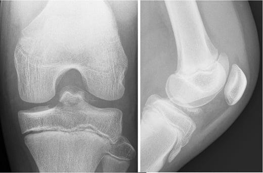 english class x knee fig25 intercondylar emincence fracture combi blanco