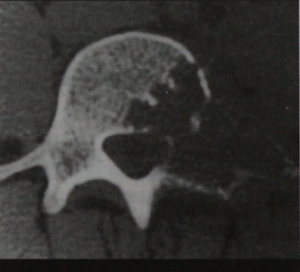 Остеобластома на МРТ