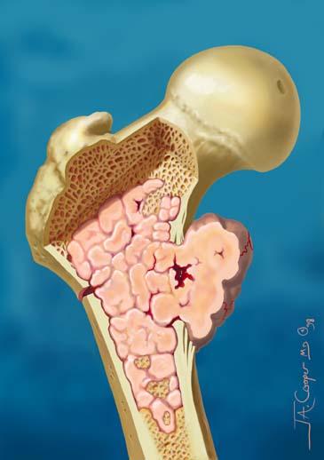 Изображение - Рынок эндопротезов суставов и костей в онкологии chondrosarcoma