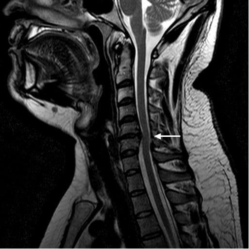 Pre operative magnetic resonance imaging scan The arrow on the sagittal T1 weighted.png