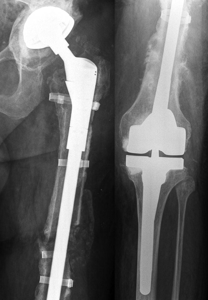 Ревизионные протезы на рентгене.