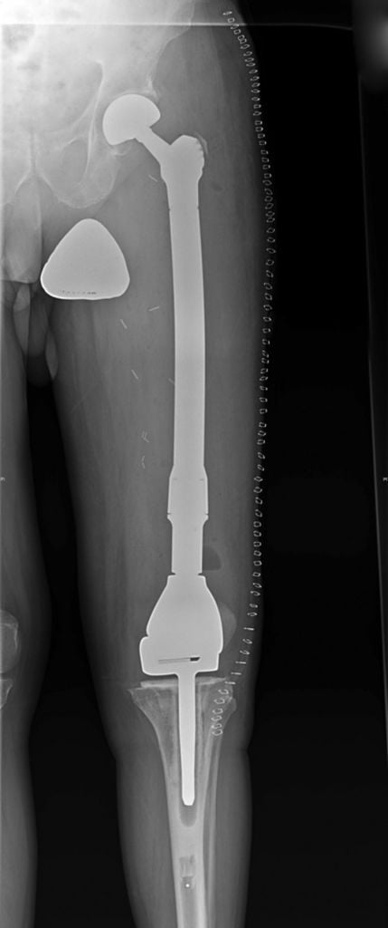 Изображение - Рынок эндопротезов суставов и костей в онкологии graphic-3.large_-429x1024