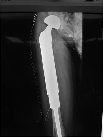 Изображение - Рынок эндопротезов суставов и костей в онкологии modulartumorprosthesis-radiograph