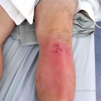 Изображение - Гемартроз после артроскопии коленного сустава ACL-infec