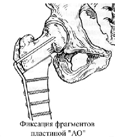 Остеотомия бедренной кости тазобедренного сустава: показания, виды операции и восстановление