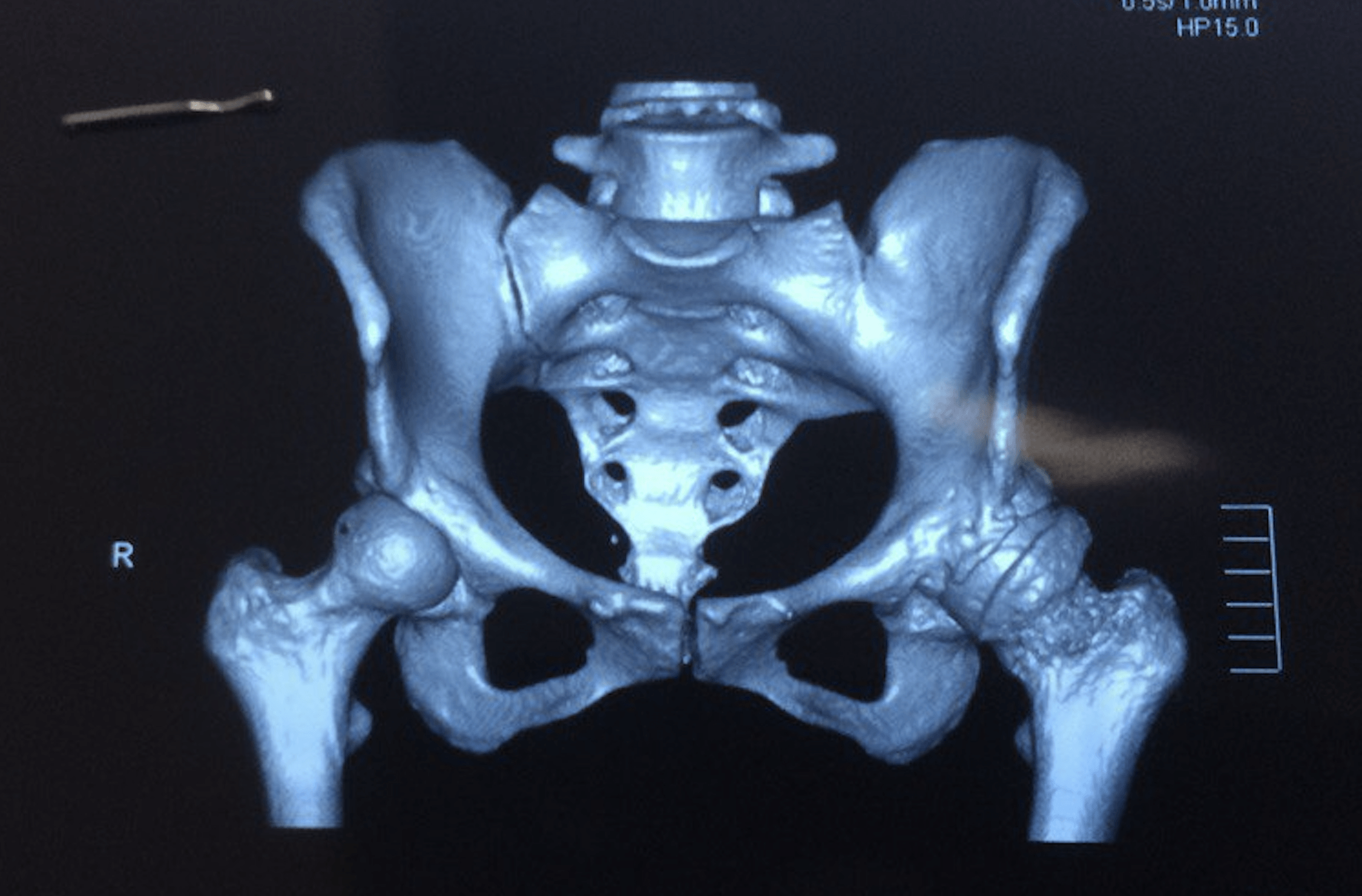 Эндопротезирование коленного сустав при остеомиелите thumbnail
