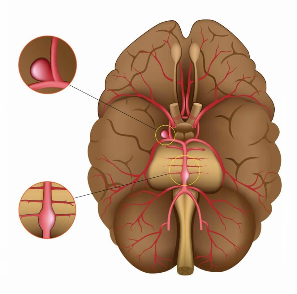 Аневризма сосудов головного мозга: симптомы и методы лечения