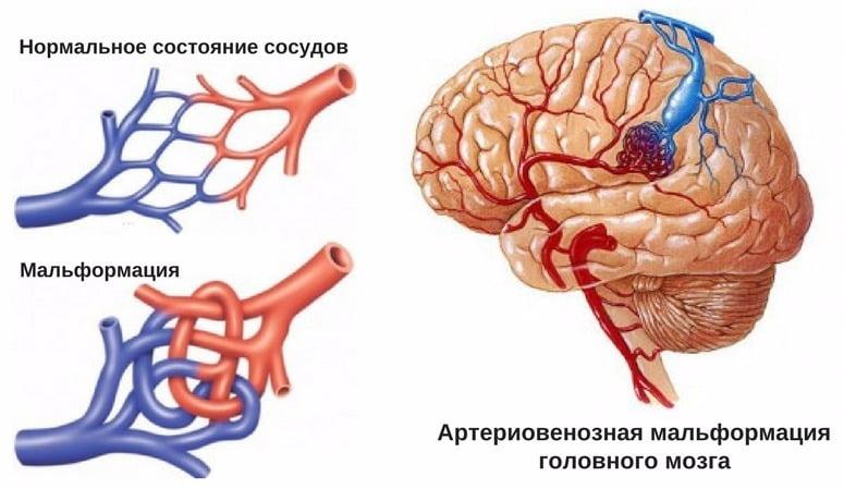 Артериовенозные мальформации сосудов головного мозга: лечение, операции и последствия