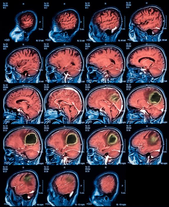 Операция по удалению абсцесса головного мозга: симптомы, лечение и последствия